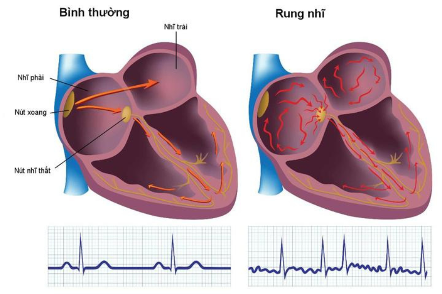 Rung nhĩ là rối loạn nhịp thường gặp trong bệnh cơ tim phì đạir