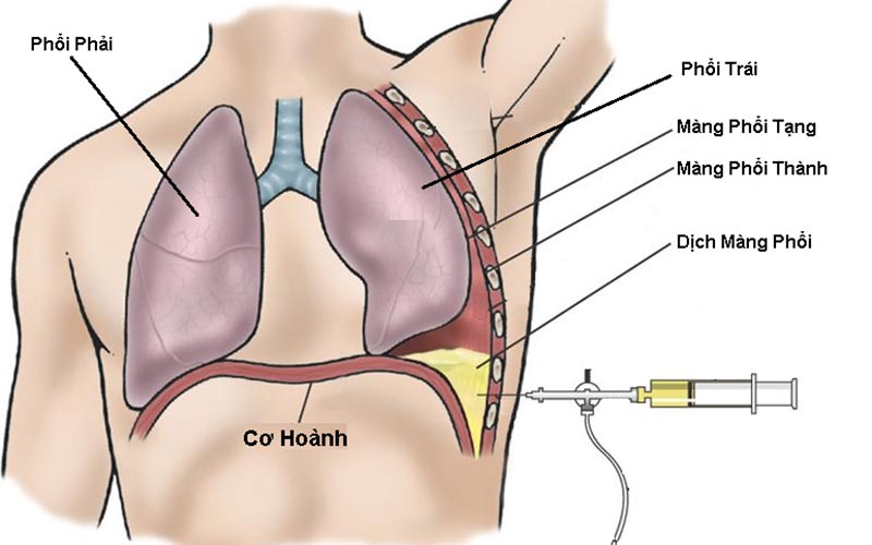 Tràn khí màng phổi: bệnh lý cấp cứu nguy hiểm trong lao