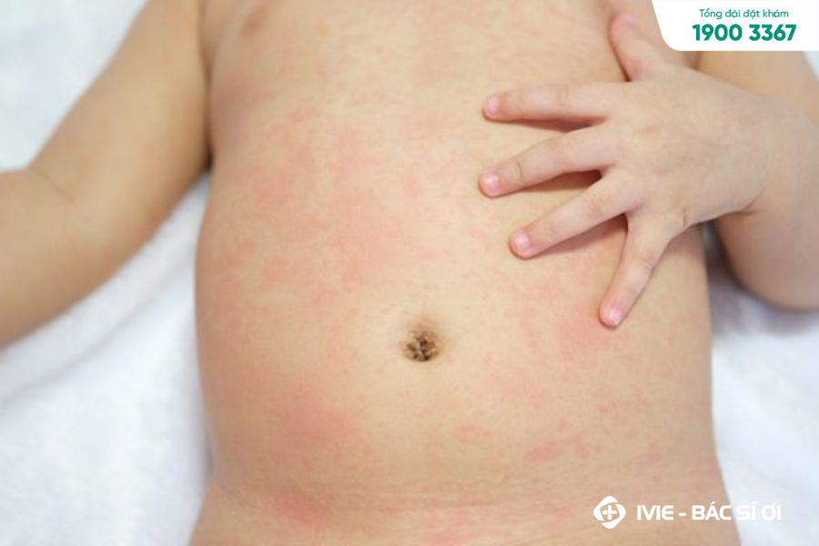 Hết sốt nổi mẩn đỏ ở trẻ em là tình trạng phổ biến ở trẻ nhỏ
