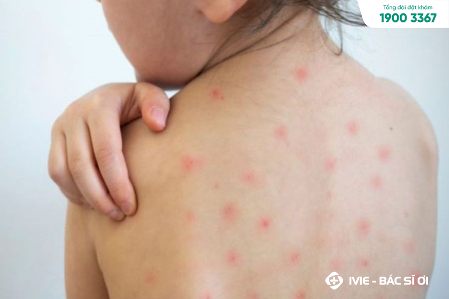 Hết sốt nổi mẩn đỏ ở trẻ em có thể là dầu hiệu của nhiều bệnh lý