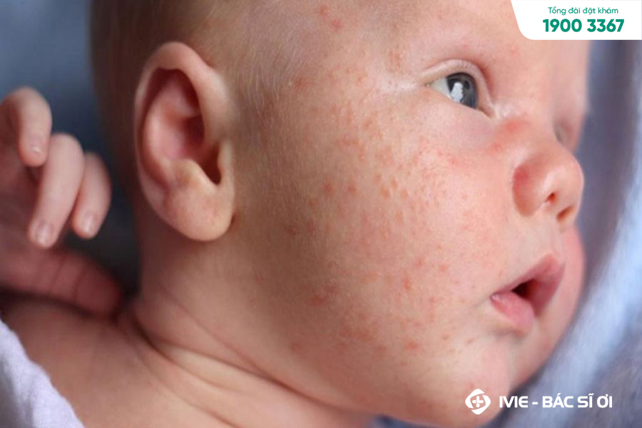 Hết sốt nổi mẩn đỏ ở trẻ em không quá nguy hiểm nhưng nếu bé sốt trên 39,5 độ thì nên đưa bé đi khám