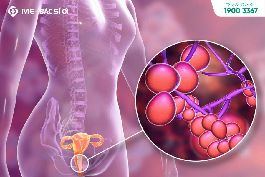 Nhiễm trùng nấm âm đạo có thể gây sau khi quan hệ bị rát khi đi tiểu