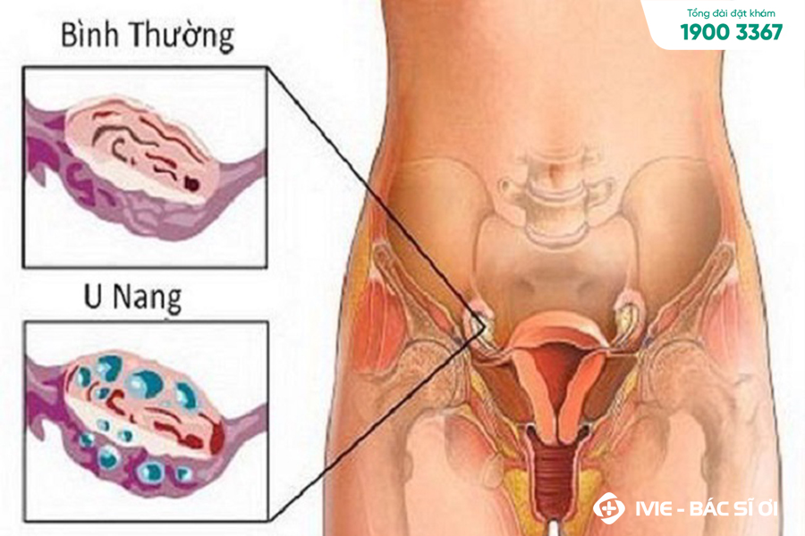 5. Các biện pháp phòng ngừa đau bụng dưới