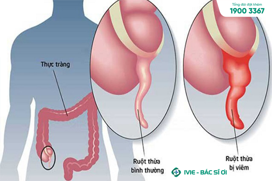 Đau bụng dưới ở phụ nữ do vấn đề về hệ tiêu hoá