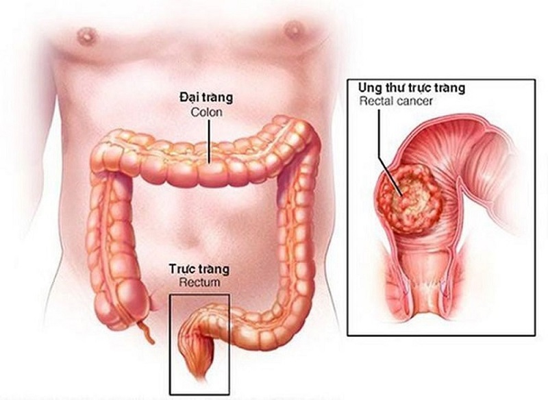 Siêu âm trực tràng