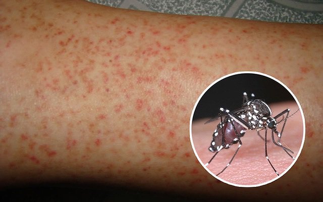 Bệnh của mùa hè: sốt xuất huyết Dengue