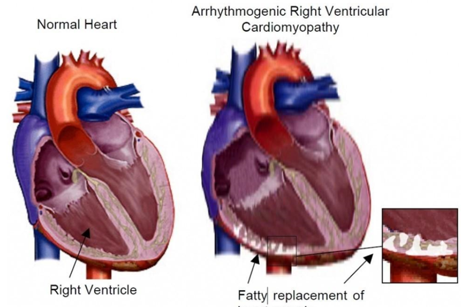Sự thay thế cơ tim bằng tổ chức mỡ (mũi tên đen) là tổn thương đặc trưng trong bệnh cơ tim thất phải gây rối loạn nhịp