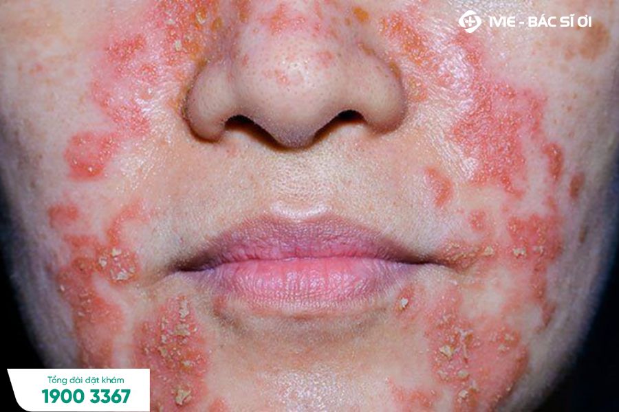 Sưng đỏ và ngứa là một trong những triệu chứng phổ biến của chàm da
