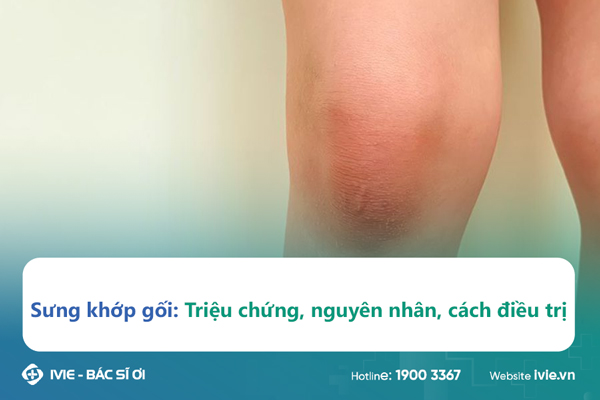 Sưng khớp gối: Triệu chứng, nguyên nhân, cách điều trị