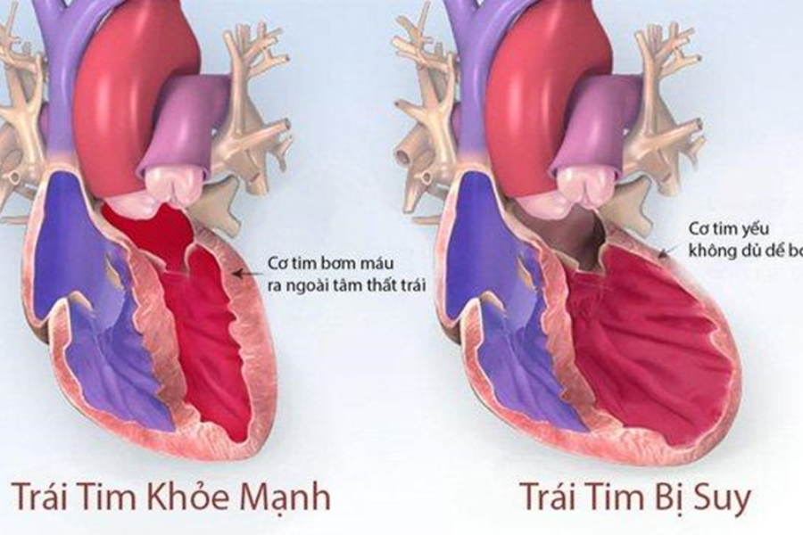 Suy tim làm giảm sức co bóp và khả năng tống máu đi nuôi cơ thể