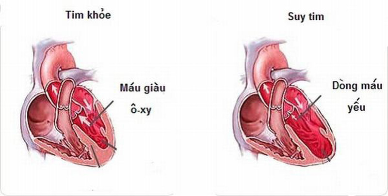 Bệnh lý về tim: Suy tim và các cấp độ của suy tim