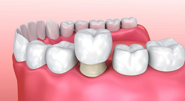 Điểm mặt 5+ tác hại của bọc răng sứ sai cách, kém chất lượng