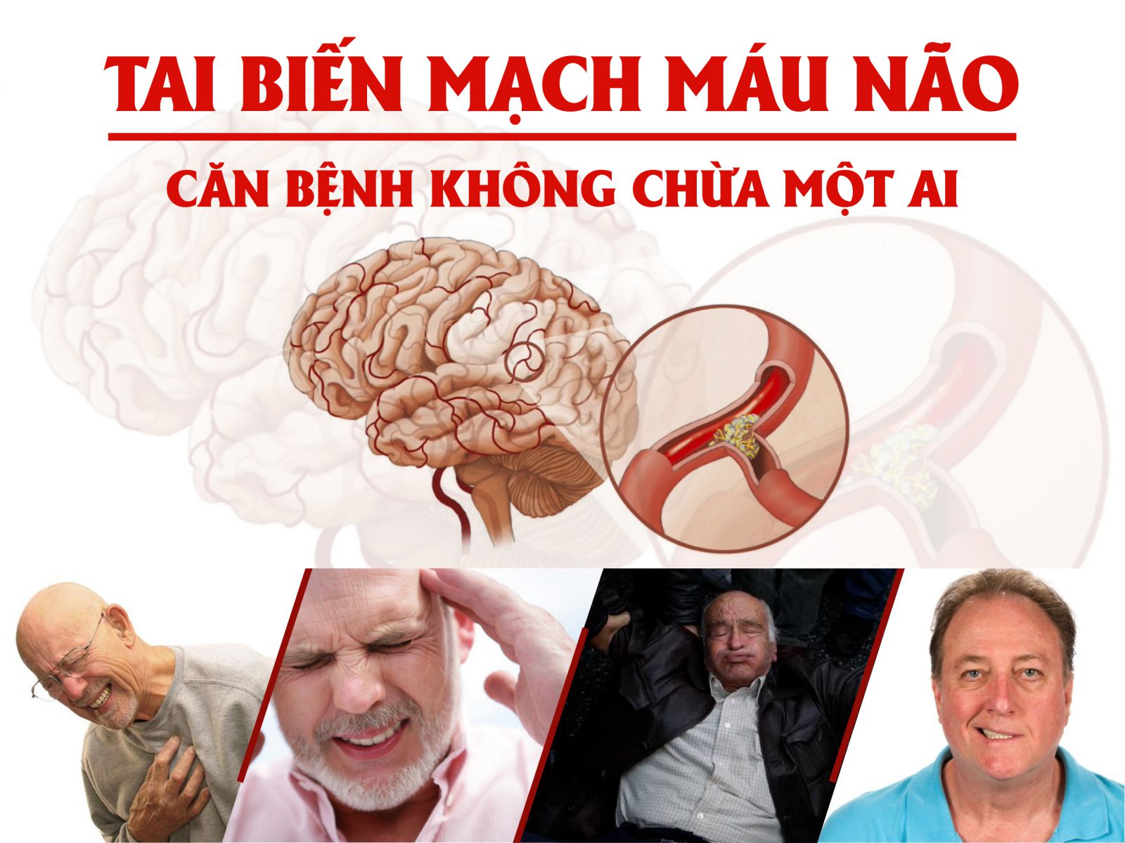 Giải phẫu động mạch não, nguy cơ tai biến mạch máu não