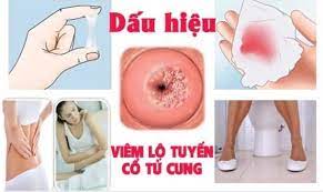 Viêm lộ tuyến cổ tử cung là gì?