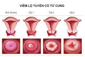 Viêm lộ tuyến cổ tử cung được chia thành ba cấp độ với các dấu hiệu lâm sàng nhận biết như: