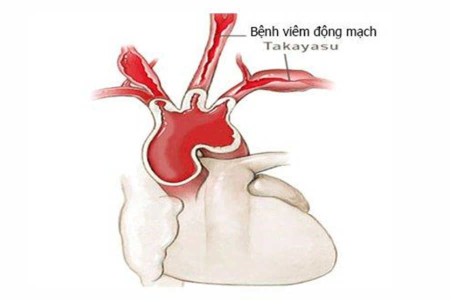 Takayasu là bệnh thường gặp trong nhóm viêm mạch máu đa cơ quan có thể gây viêm màng ngoài tim