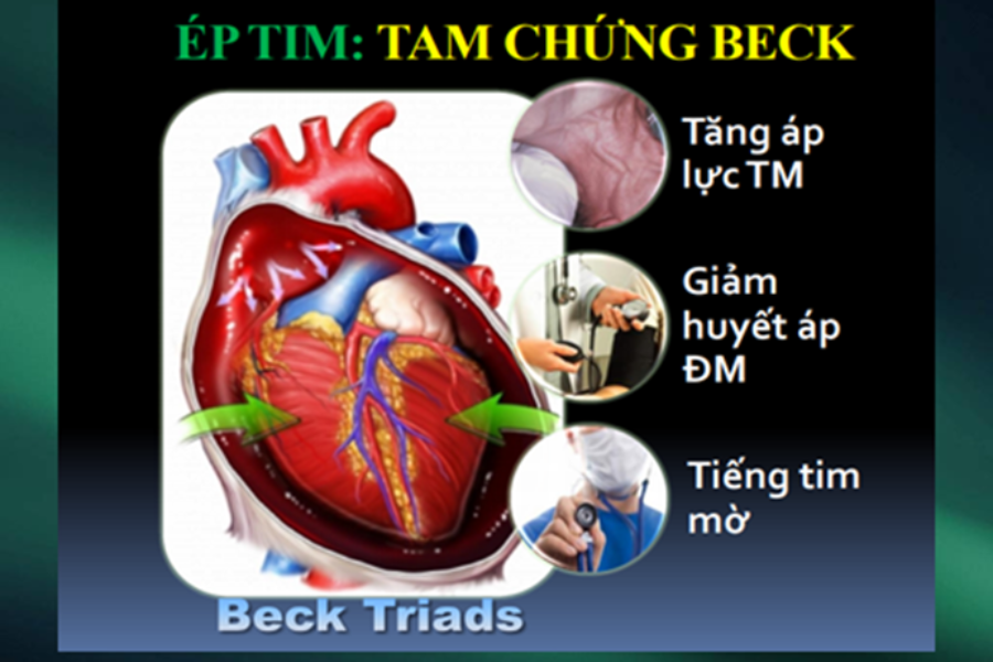 Tam chứng Beck là dấu hiệu điển hình của tràn dịch màng ngoài tim cấp có ép tim, một chỉ định nhập viện của viêm màng ngoài tim