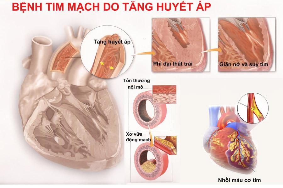 Bệnh động mạch vành – một trong số các biến chứng của tăng huyết áp.