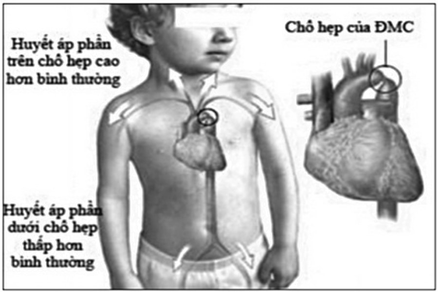 Hẹp eo động mạch chủ, một trong những nguyên nhân gây tăng huyết áp ở người trẻ và trẻ em