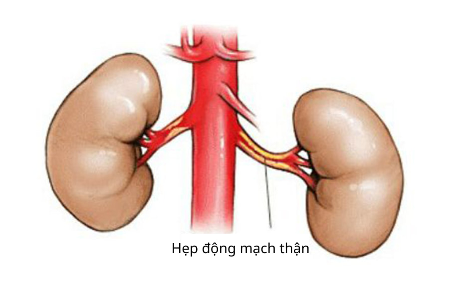 Hẹp động mạch thận, một trong những nguyên nhân thường gặp nhất gây tăng huyết áp thứ phát