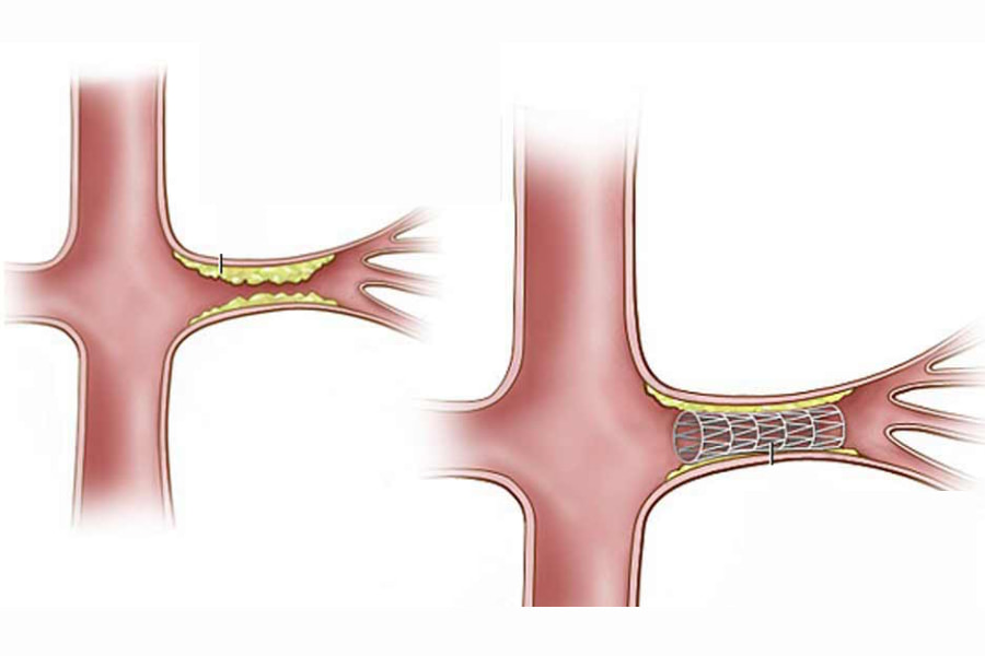 Can thiệp stent động mạch thận: phương pháp hiện đại, ít xâm lấn điều trị hẹp động mạch thận