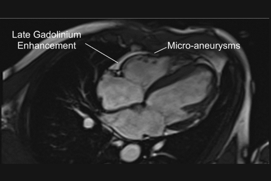 Tăng tín hiệu muộn với gadolinium và phình mỏm thất phải (gạch ngang trắng) trên chụp cộng hưởng từ tim