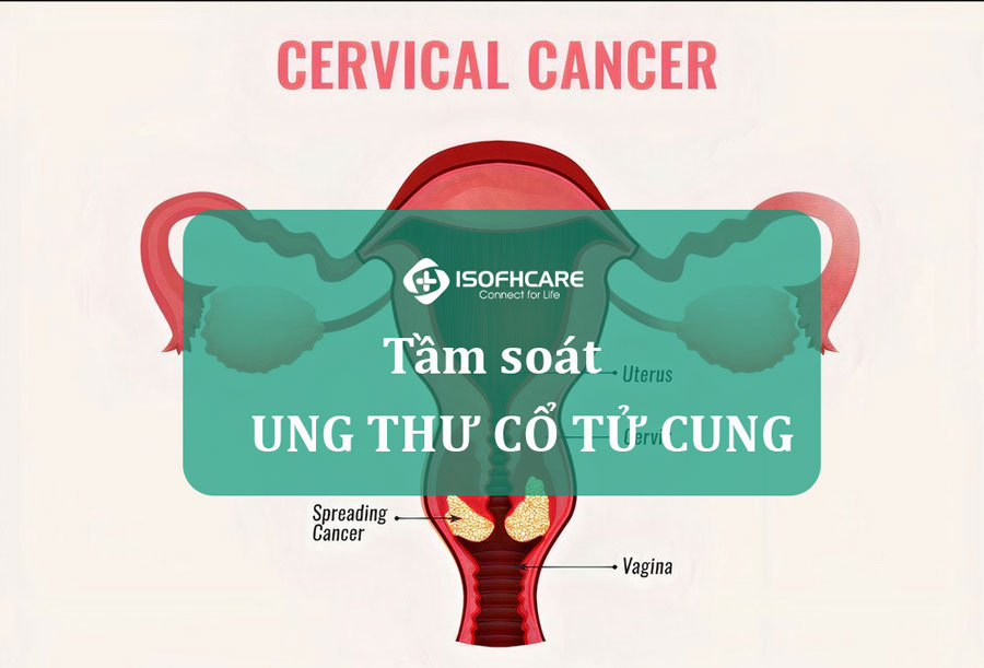 Tầm soát ung thư cổ tử cung ở nữ giới