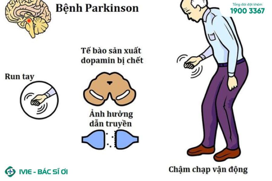 Parkinson có nguy hiểm không?