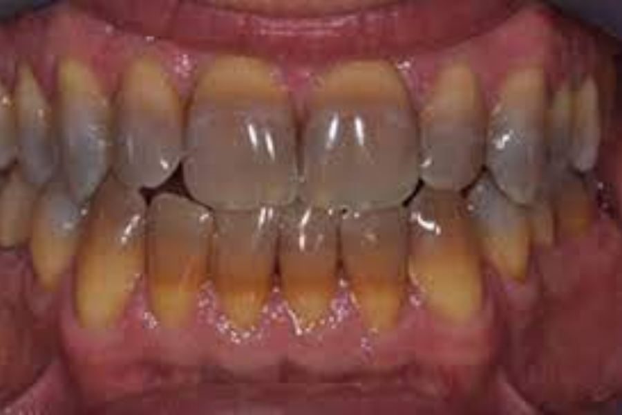 Nhiễm màu răng không đồng nhất, thiểu sản men ngà, nhiễm fluor đốm màu lớn.