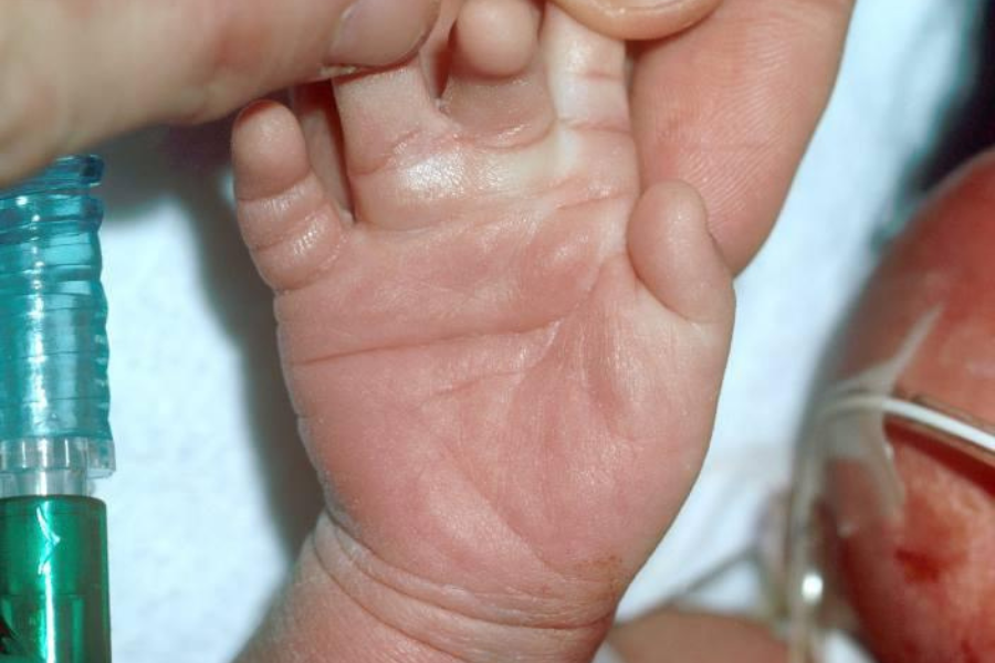 Nếp nang đơn độc ở bàn tay trẻ mắc hội chứng Down