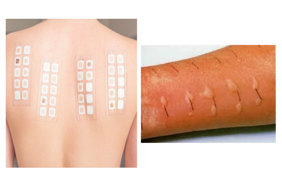 Test áp da và Test lẩy da