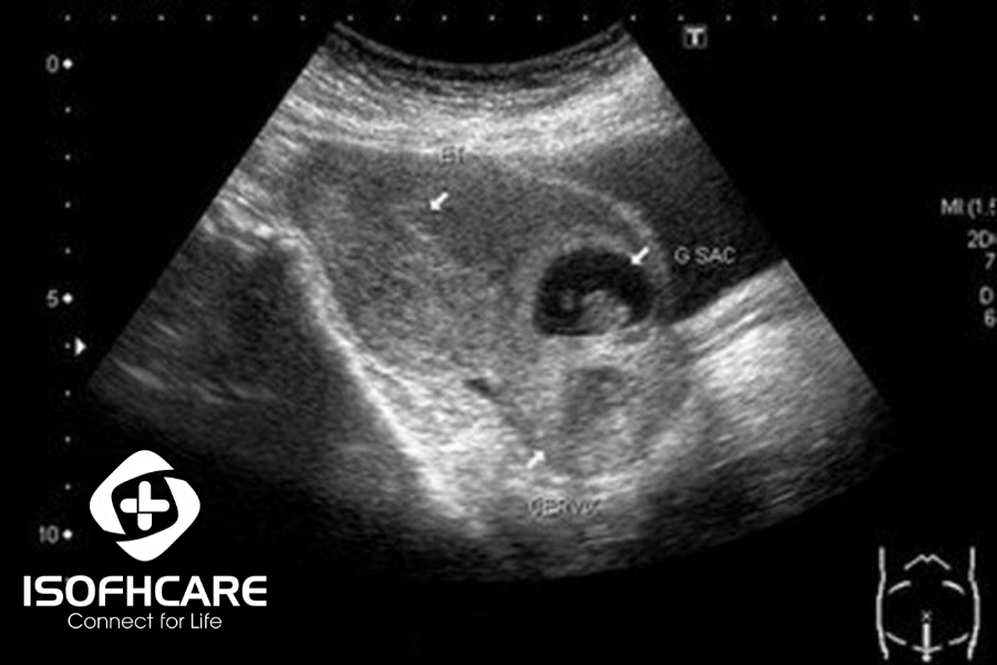 siêu âm thai 2D thai ở sẹo mổ lấy thai