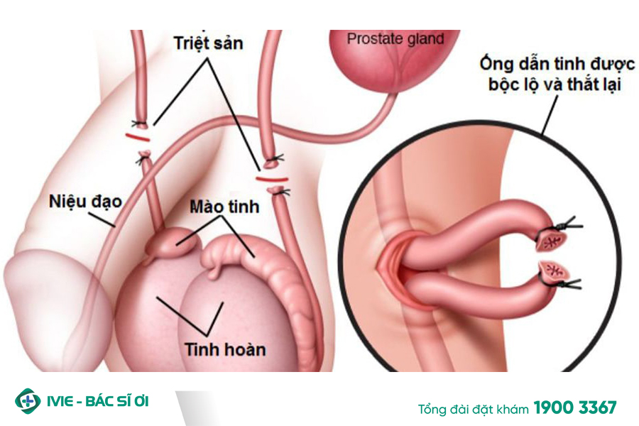 Quá trình thắt ống dẫn tinh