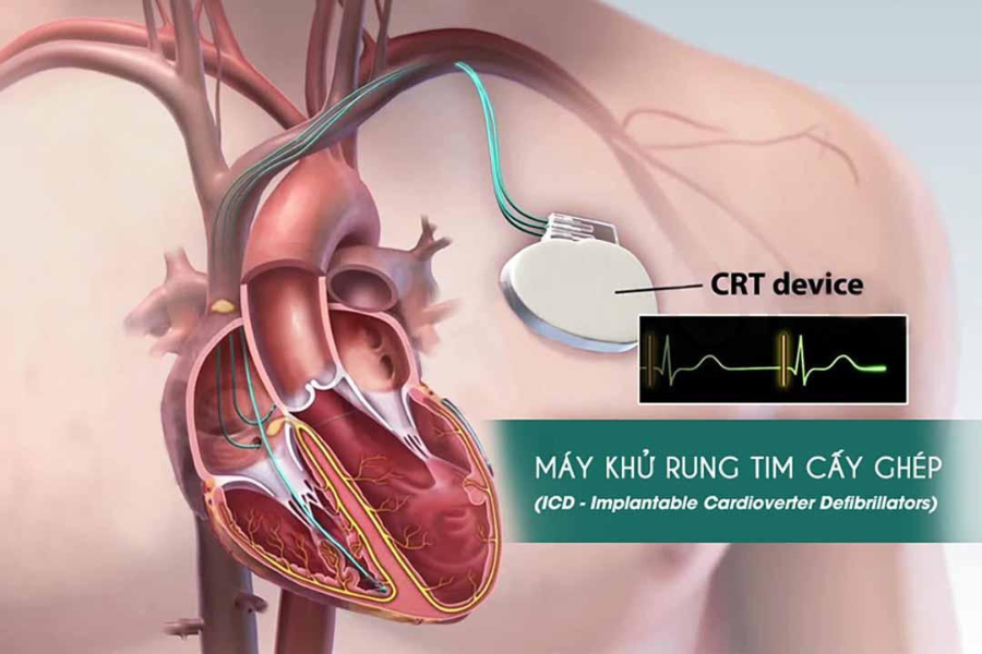 CRT và ICD là 2 thiết bị cấy ghép hỗ trợ hiện đại rất cần với người bệnh cơ tim giãn bị suy tim nặng và / hoặc có rối loạn nhịp nguy hiểm