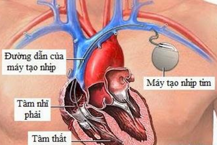 Người bệnh có thể cần đặt máy tạo nhịp tim nếu bị rối loạn nhịp nguy hiểm