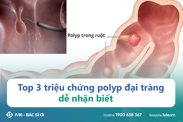  3 triệu chứng polyp đại tràng dễ nhận biết