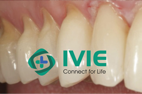 Các bước trám phục hồi mòn cổ răng bằng Composite