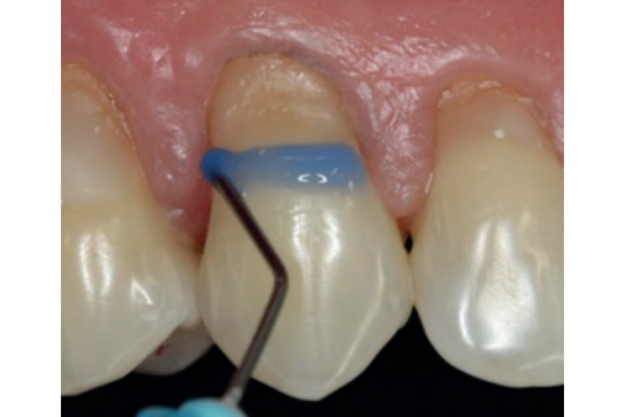 Trám phục hồi cổ răng bằng Composite
