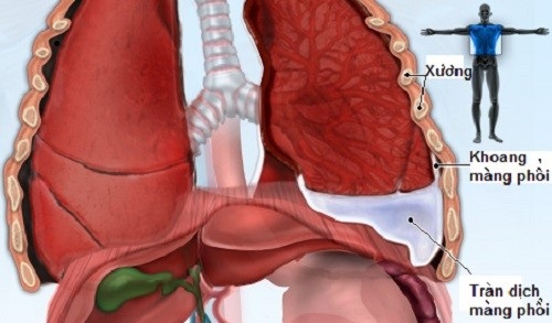 Lao màng phổi có phải là thể bệnh nguy hiểm không?