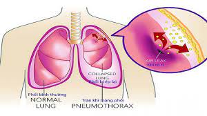 Phân loại tràn khí màng phổi theo các trường hợp của thể...