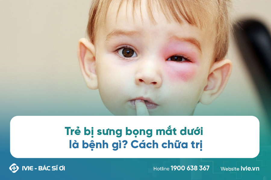 Trẻ bị sưng bọng mắt dưới là bệnh gì? Cách chữa trị