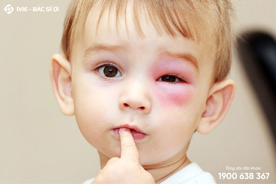 Trẻ bị sưng bọng mắt dưới có thể gây nên bởi nhiều nguyên nhân khác nhau