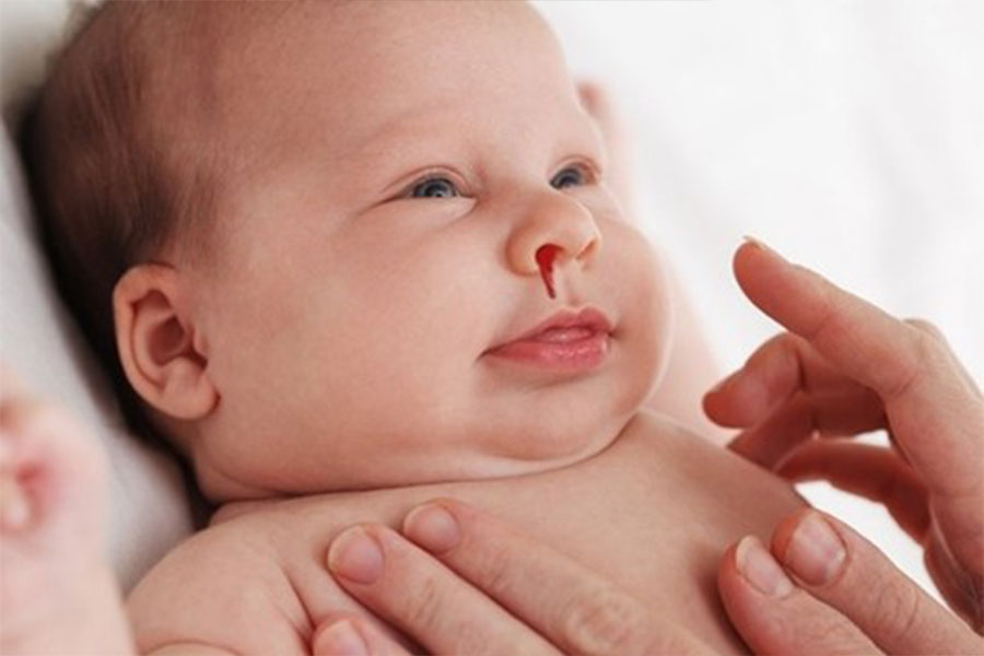 Trẻ bị chảy máu mũi khi ngủ thường không quá nguy hiểm nhưng cha mẹ sơ cứu đúng cách để trẻ không bị mất máu quá nhiều