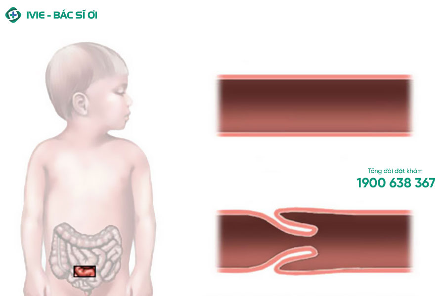 Trẻ bị đau bụng quanh rốn từng cơn có thể do lồng ruột