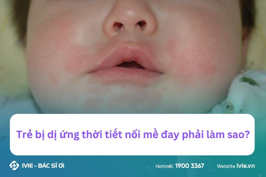 Trẻ bị dị ứng thời tiết nổi mề đay phải làm sao?