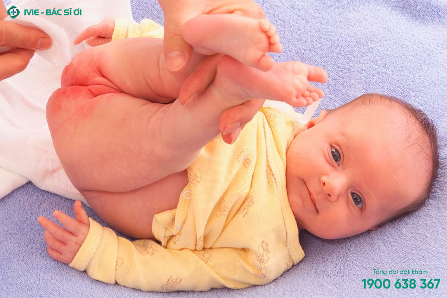 Trẻ sơ sinh bị hăm đỏ hậu môn giới hạn ở một phần rất nhỏ của khu vực mặc tã