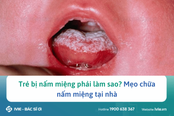 Trẻ bị nấm miệng phải làm sao? Mẹo chữa nấm miệng tại nhà