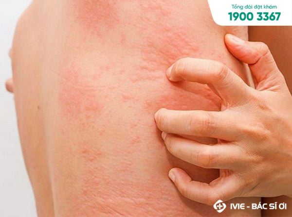 Trẻ nổi mày đay ngứa khắp người có nguy hiểm không?