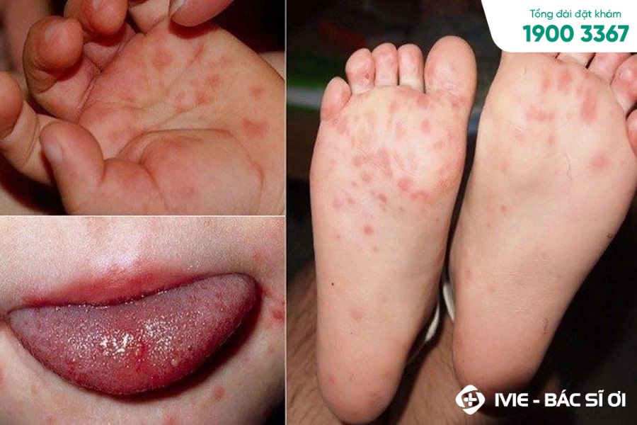 Bệnh tay chân miệng là bệnh lý do virus khá phổ biến ở trẻ nhỏ