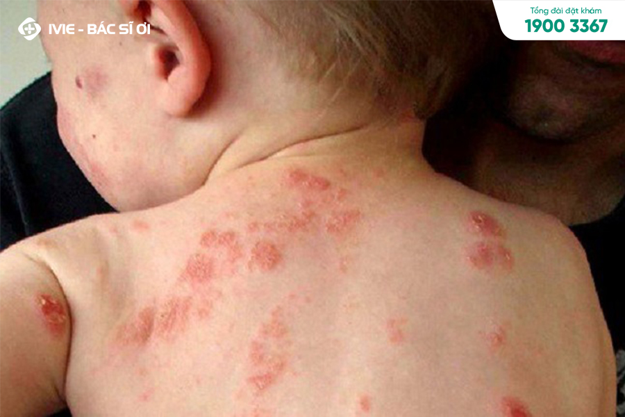 Viêm da nhiễm khuẩn gặp ở trẻ tại những vùng da khác nhau